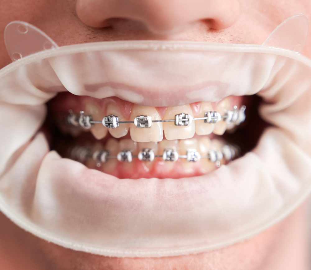Damon Braces  Visalia, CA