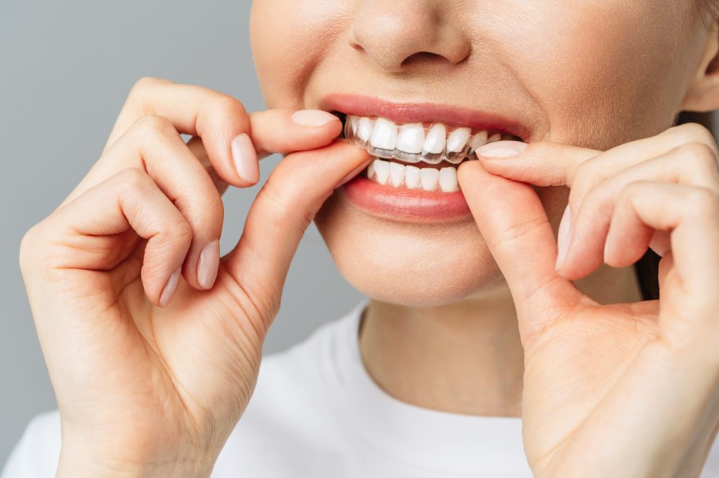 ClearCorrect and Invisalign Devices